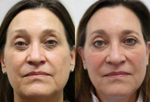 Before-and-after image of a middle-aged woman’s face following an injectable treatment.