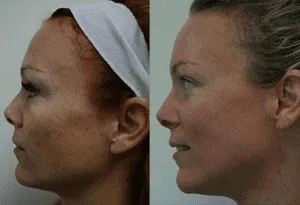 Before and after side profile of a woman's face post-plastic surgery.