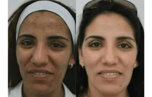 Before and after comparison of a woman's facial transformation post-plastic surgery.