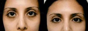 Before and after images of woman's eye area showcasing eyelid surgery results.