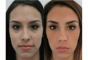 Before and after images of a woman's face showing results of cosmetic surgery.