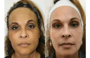 Before and after facial rejuvenation treatment showing improved skin texture.