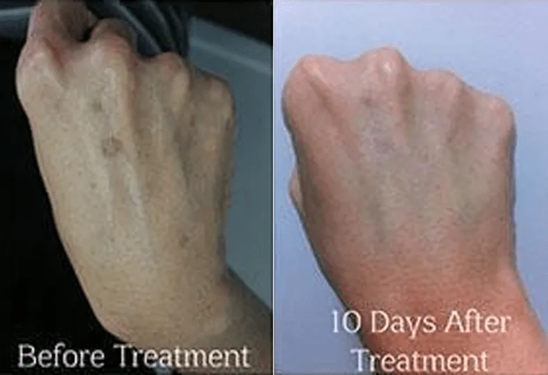 Before and after hand rejuvenation treatment showing reduced skin blemishes.