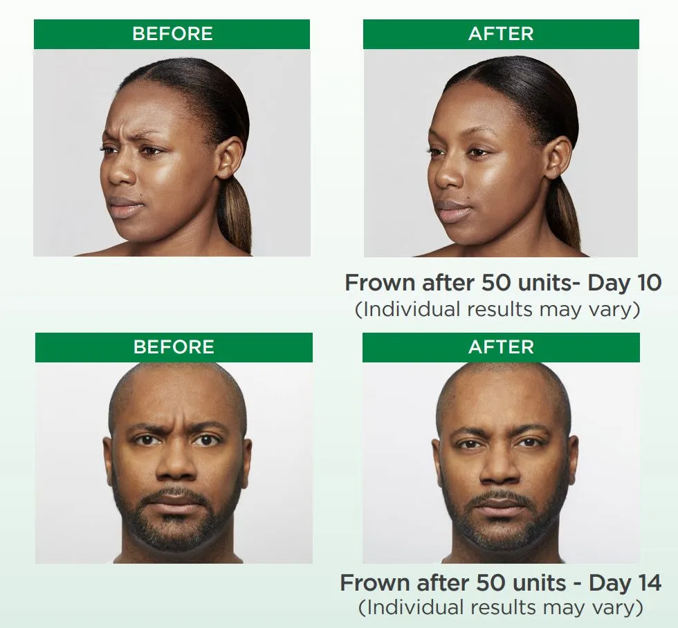 Before and after comparison showing results of 50 units of treatment on frown lines over 10 to 14 days.