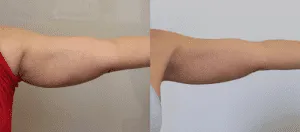 Before and after arm lift surgery showing reduced sagging skin.