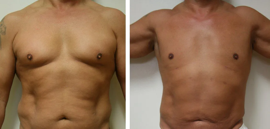Male chest before and after gynecomastia surgery.
