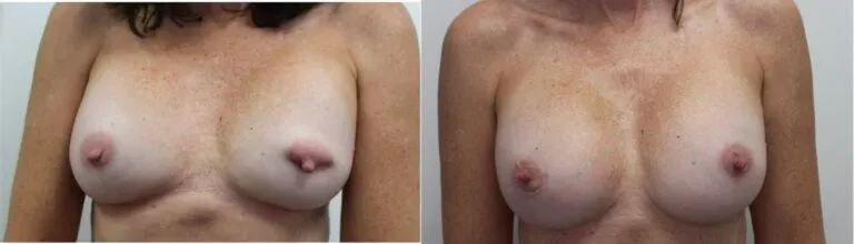 Before and after image showing the results of breast augmentation surgery.