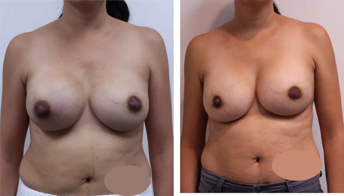 Before and after breast augmentation surgery comparison showing improved symmetry and size.