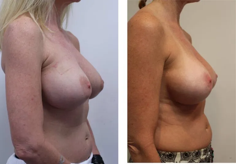 Before and after breast augmentation side profile comparison.