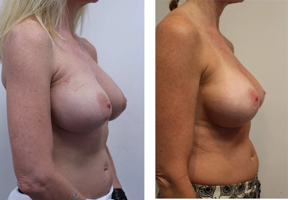 Before and after breast augmentation side profile comparison.
