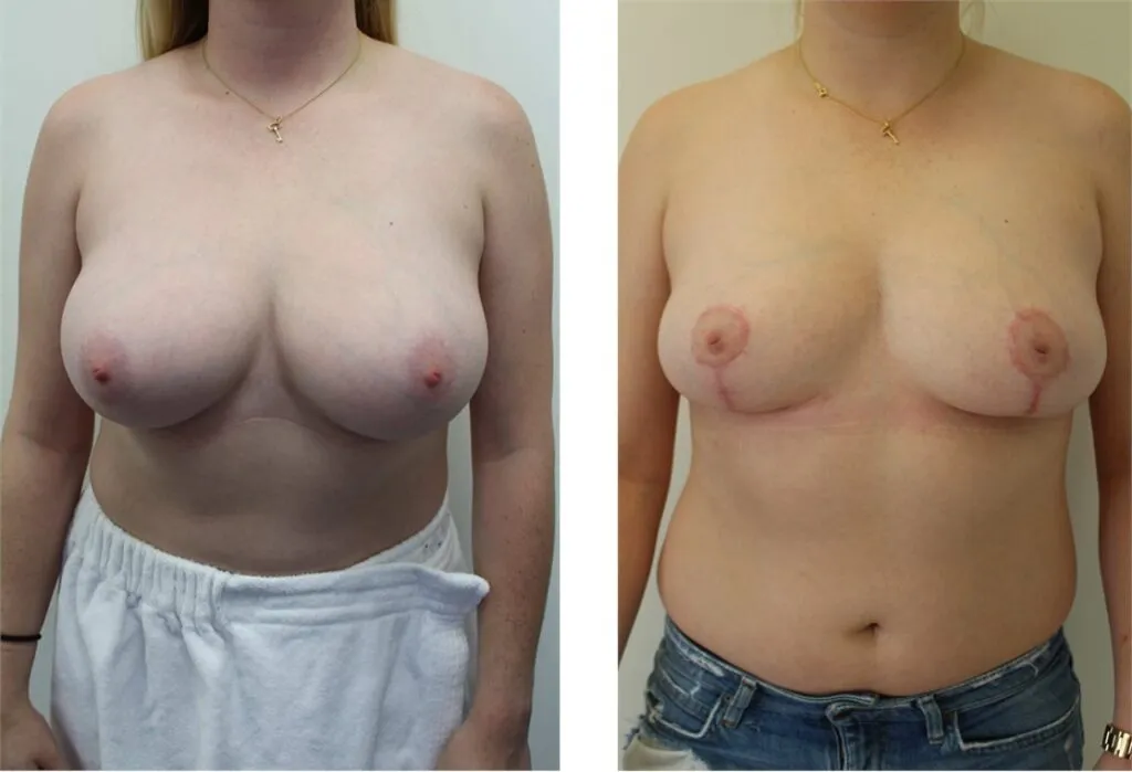 Before and after breast reduction surgery showing improved symmetry and contour.