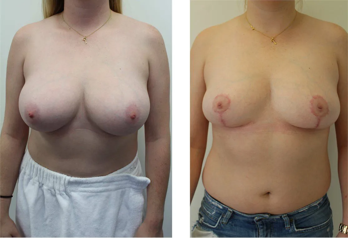 Before and after breast reduction surgery showing improved symmetry and contour.