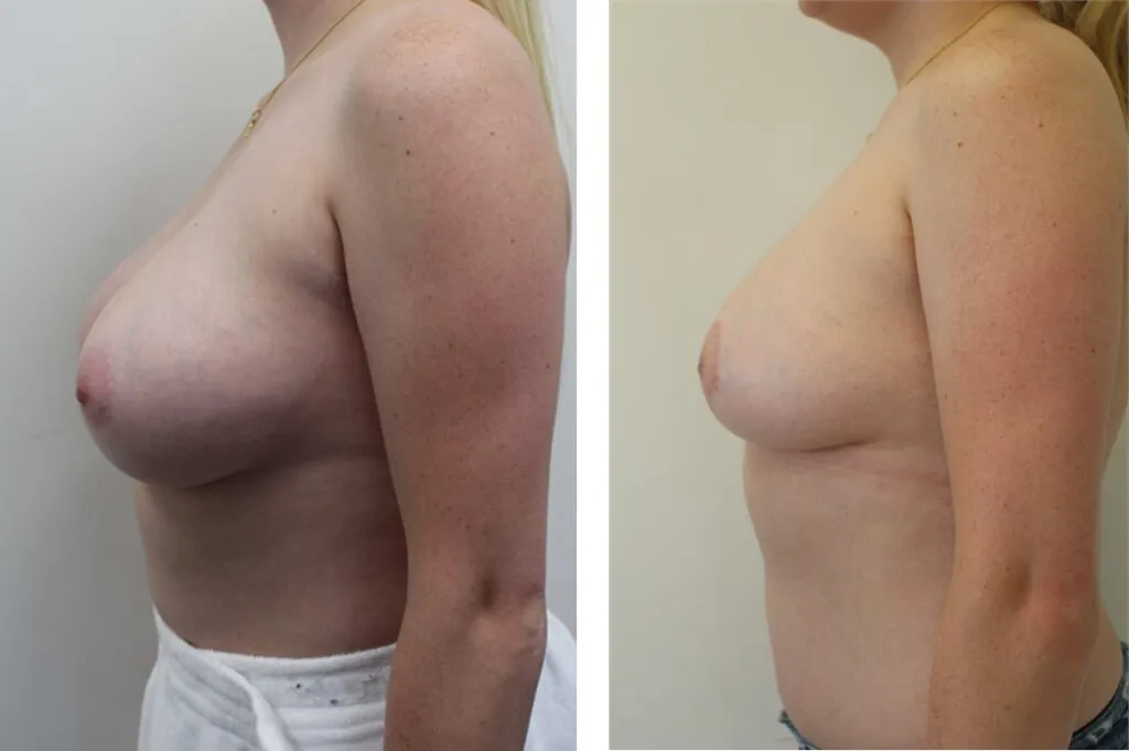 Before and after breast reduction surgery profile view.