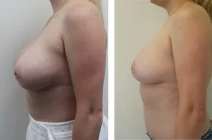 Before and after breast reduction surgery profile view.
