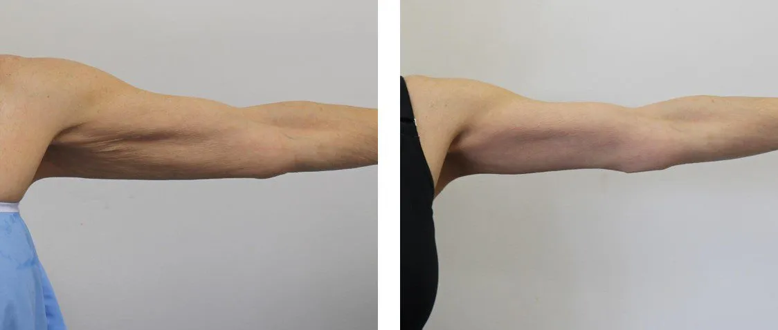 Before and after results of arm lift surgery showing reduced sagging skin.