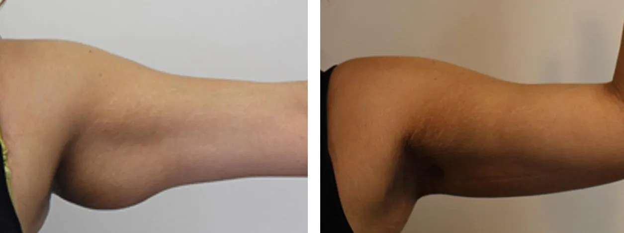 Before and after photo of arm lift surgery showing reduced sagging skin.