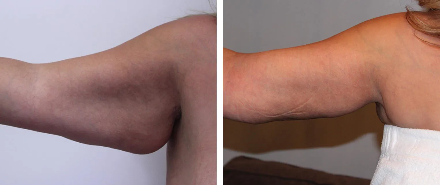 Before and after images of an arm lift surgery showing skin tightening results.