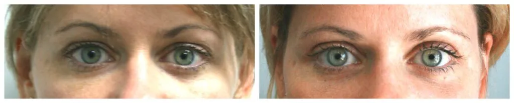 Before and after blepharoplasty eye surgery showing reduced eyelid puffiness.