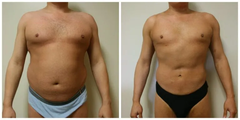 Before and after image of a man's torso showing results of liposuction.