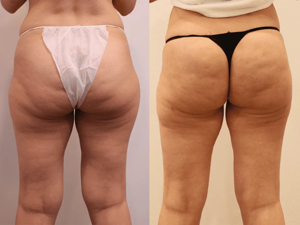 Before and after image of a woman's lower body showing results of cosmetic surgery at a plastic surgery center.