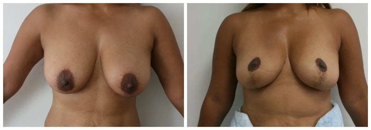 Before and after breast augmentation comparison showing enhanced symmetry and size.