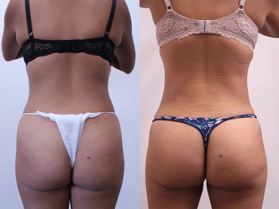 Before and after plastic surgery results showcasing enhanced body contouring.