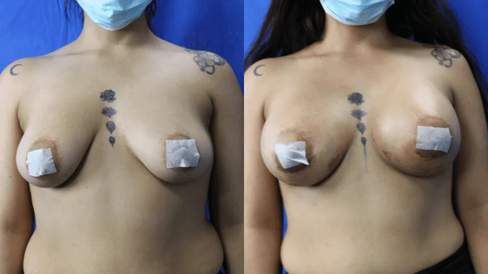 Before and after image of breast augmentation surgery results on a female patient with tattoos.