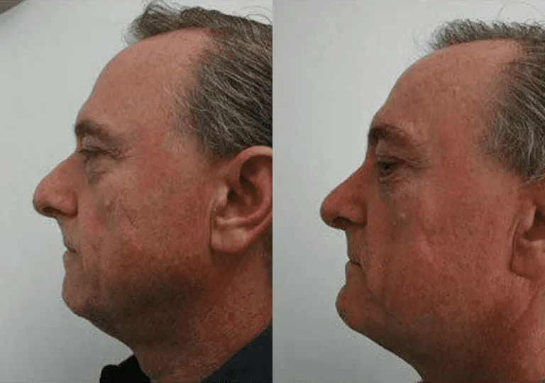 Before and after rhinoplasty profile view of a male patient.