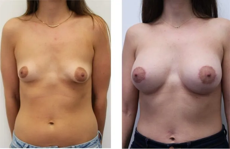 Before and after breast augmentation surgery showing enhanced size and shape.