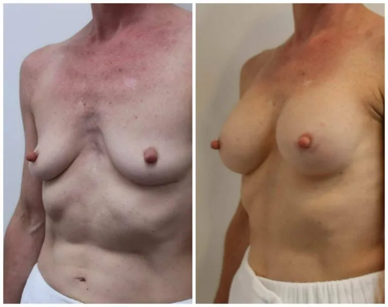 Before and after breast augmentation surgery results.