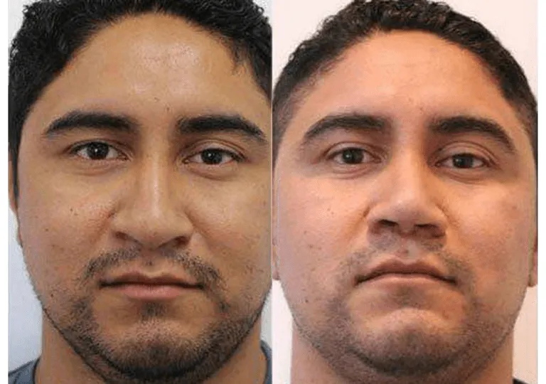 Before and after rhinoplasty results on male patient.