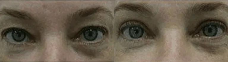 Before and after images of eyelid surgery demonstrating reduced puffiness and rejuvenated appearance.