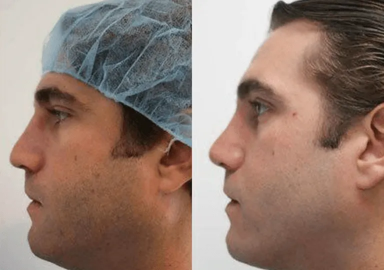 Before and after male rhinoplasty profile comparison at a plastic surgery center.