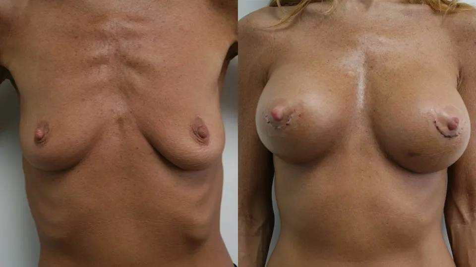 Before and after breast augmentation surgery results.