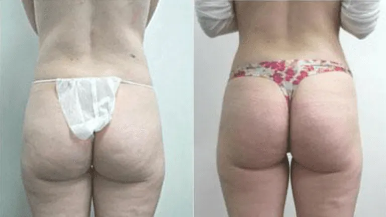 Before and after photo of buttock enhancement surgery results.