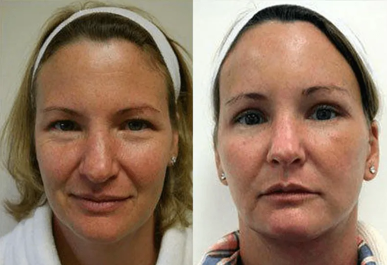 Before and after plastic surgery comparison of a woman's face showing aesthetic improvements.