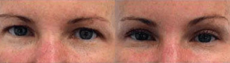 Before and after eyelid surgery comparison showing improved appearance.