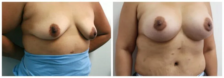 Before and after image of breast reduction surgery results.