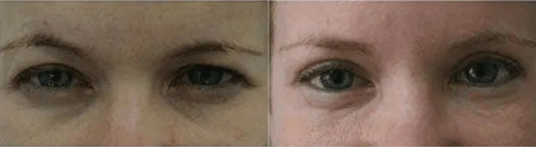 Before and after eyelid surgery showing reduced puffiness and smoother skin.