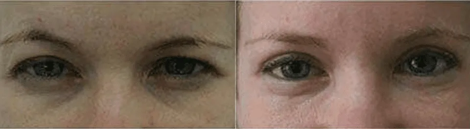 Before and after eyelid surgery showing reduced puffiness and smoother skin.