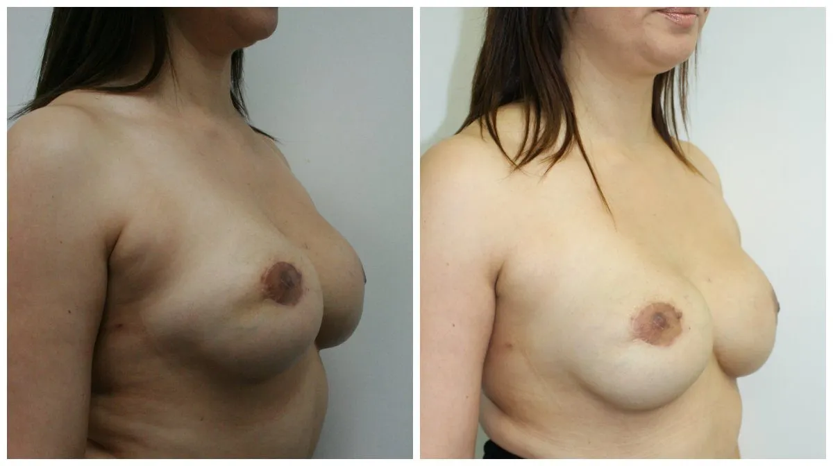 Breast augmentation before and after side view comparison.