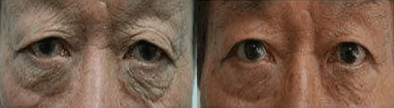Before and after eyelid surgery showing reduced wrinkles and improved eye appearance.