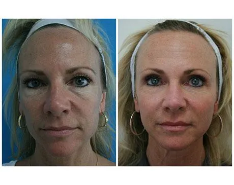 Before and after facial rejuvenation showing improved skin tone and texture.