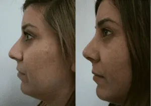 Before and after profile images of a woman showing rhinoplasty results.