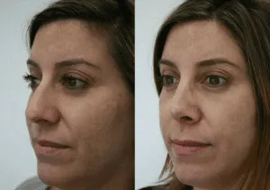 Before and after facelift transformation showcasing smoother skin and enhanced facial contours.