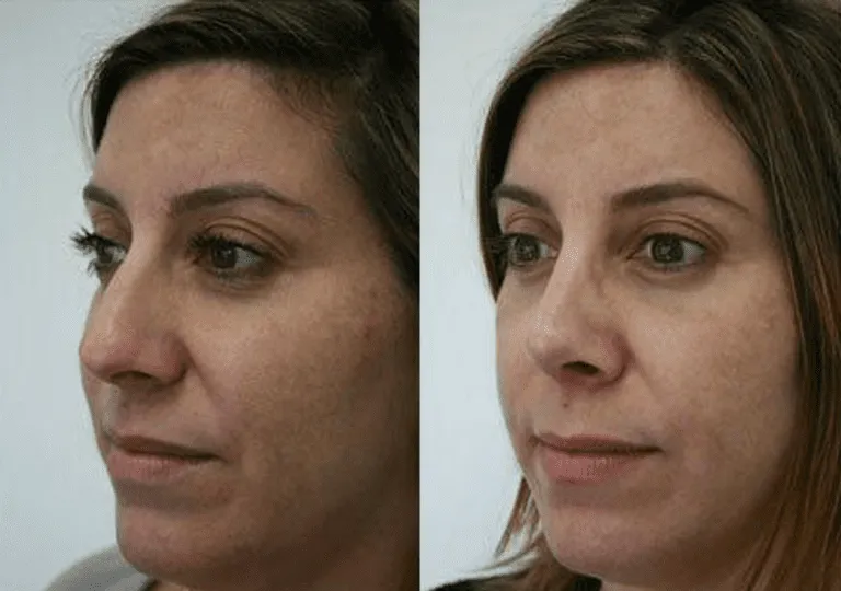 Before and after facelift transformation showcasing smoother skin and enhanced facial contours.