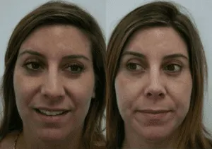 Before and after images of a woman undergoing cosmetic surgery.