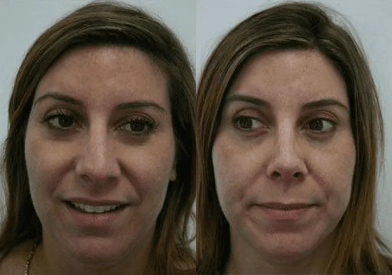 Before and after images of a woman undergoing cosmetic surgery.