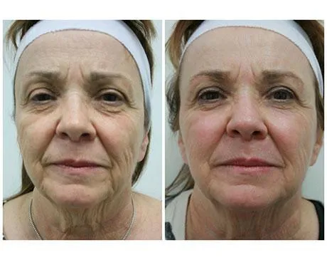 Before and after facial rejuvenation treatment on an older woman.