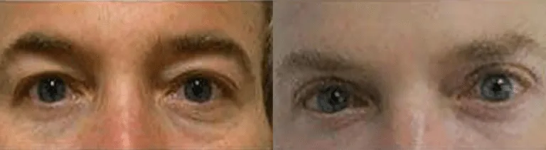 Before and after blepharoplasty showing improved eyelid appearance.